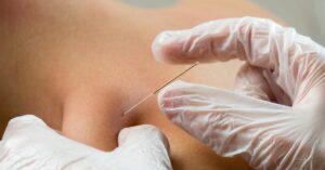 dry needling