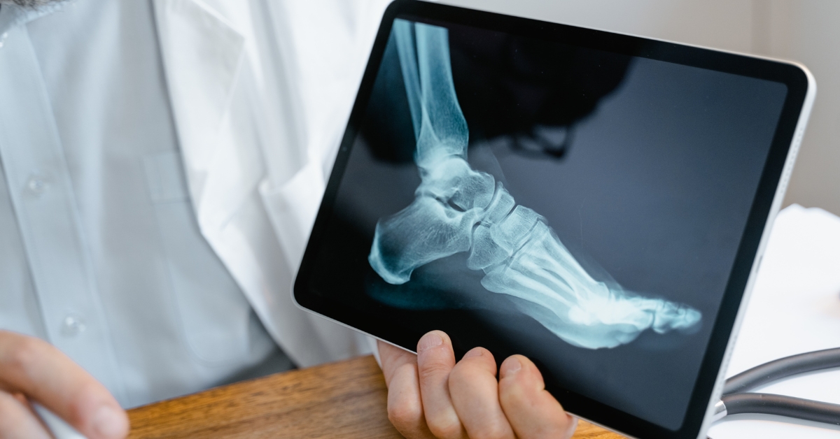 sprained foot